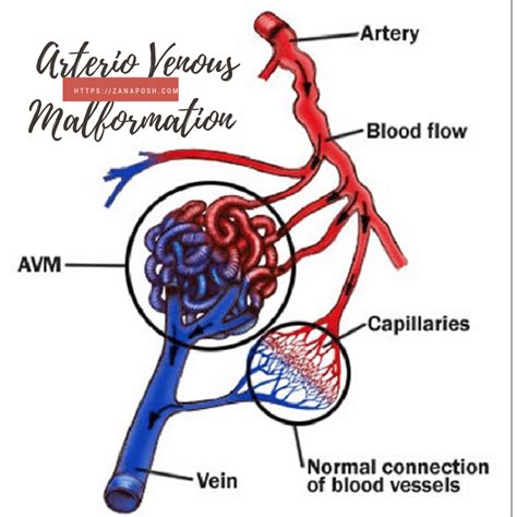 A Visual Guide To Deep Vein Thrombosis Artofit