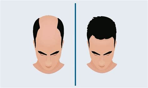 Quick Tips To Choose The Best Hair Transplant Clinic