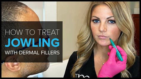 Faq Bay Area Expert Shows How To Treat Jowls With Dermal Fillers Youtube