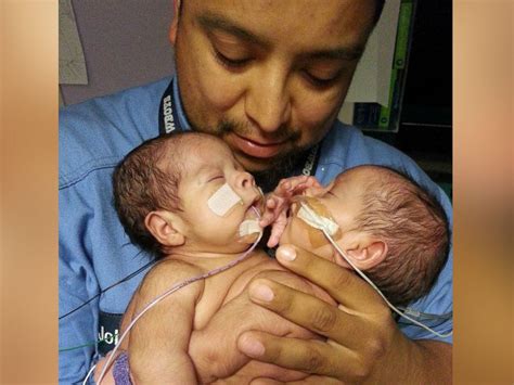 Having Hope And Faith Inside Dramatic Surgery To Separate Conjoined