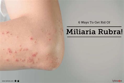 6 Ways To Get Rid Of Miliaria Rubra By Dr Ankit M Saxena Lybrate