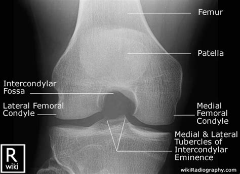 Normal Knee X Rays Bone And Spine