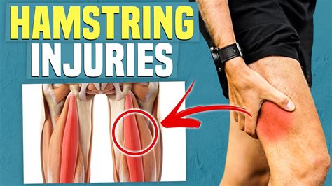 Hamstring Injuries Symptoms Causes Treatment Youtube