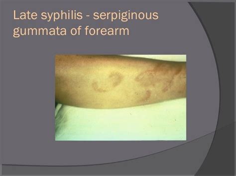 Syphilis 3