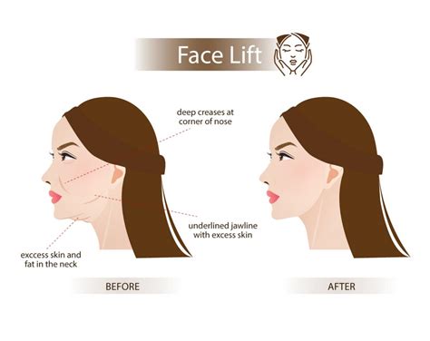 Full Face Lift Nida Esthetic Cosmetic Surgery Bangkok