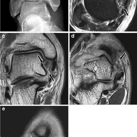 Pdf Deltoid Ligament In Acute Ankle Injury Mr Imaging My Xxx Hot Girl