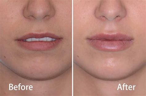 Juvederm Lips Fillers Facial Cosmetic Surgery Dr Antipov