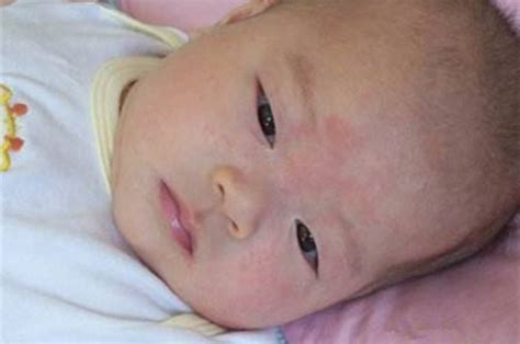 婴儿湿疹是怎么引起的原因（宝宝湿疹反复出现，引起的原因你知道吗？尤其这几点要注意） 说明书网