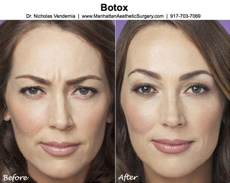 I have been exploring things for so long now. Botox, Dysport and Xeomin! Which is best? | Injectable ...