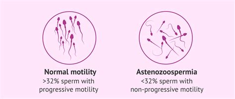 Icsi To Treat Asthenozoospermia Or Abnormal Sperm Motility