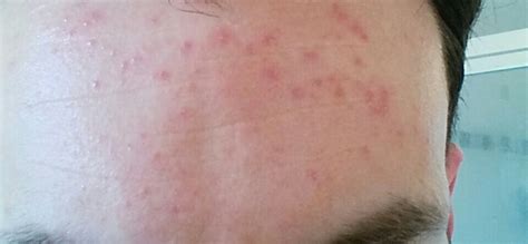 Can Someone Help Identify This Facial Rash Dermatitis And Eczema