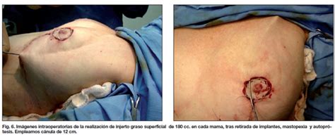 Retirada de implantes mamarios y corrección simultánea con colgajo