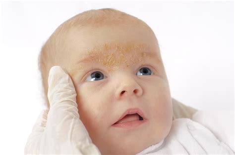 Rash On A Babys Face Pictures Causes And Treatments