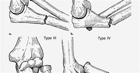 尺骨近端骨折ulnar Proximal Fracture 小小整理網站 Smallcollation