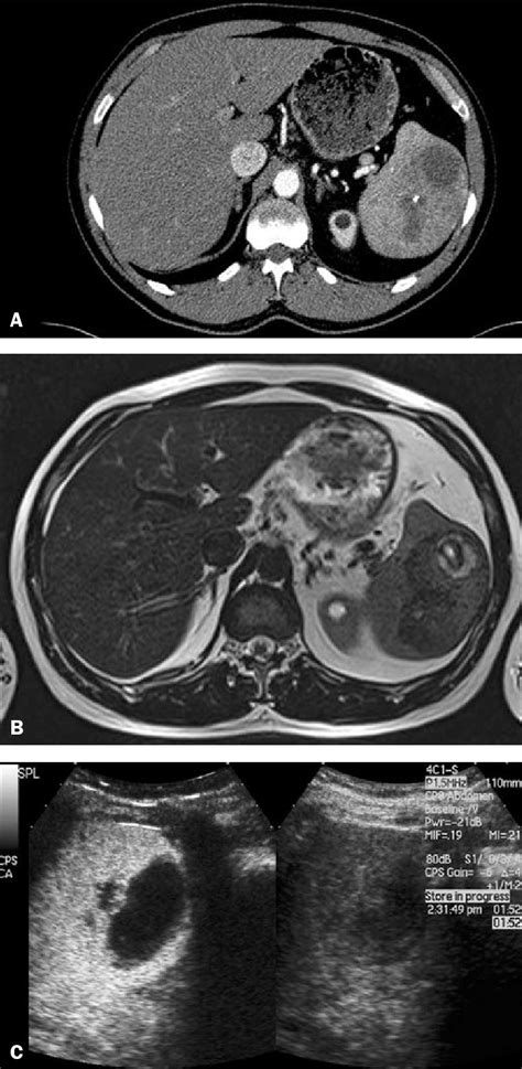 Splenic Hamartoma A Venous Phase Contrast Enhanced Ct Scan Showing A