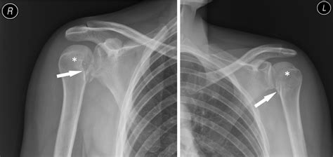 Bilateral Posterior Shoulder Dislocation With Reverse Hill Sachs Lesion