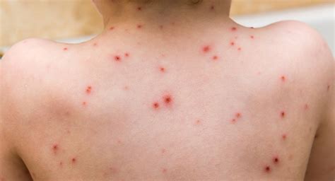 Chickenpox In Children Ages One To Five Babycentre Uk