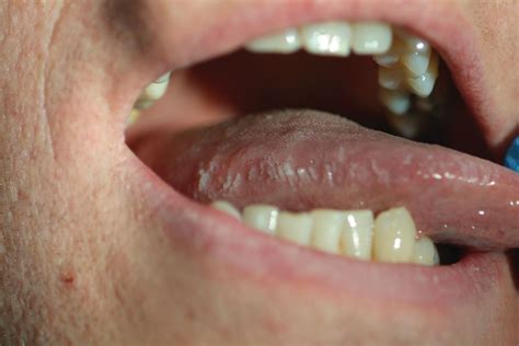 Oral Hairy Leukoplakia Arising In A Patient With Hairy Cell Leukaemia