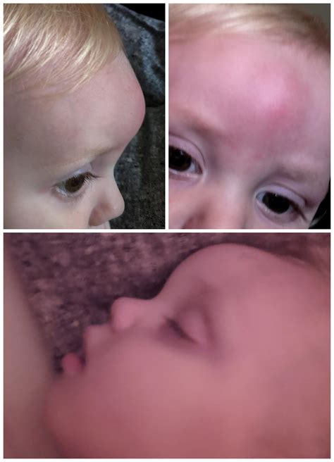 Very Swollen Forehead From Bug Bite On 17 Month Old We Noticed A