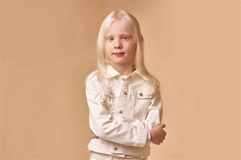 Albinism Pictures Facts Symptoms Causes Treatment Albinism The Best Porn Website