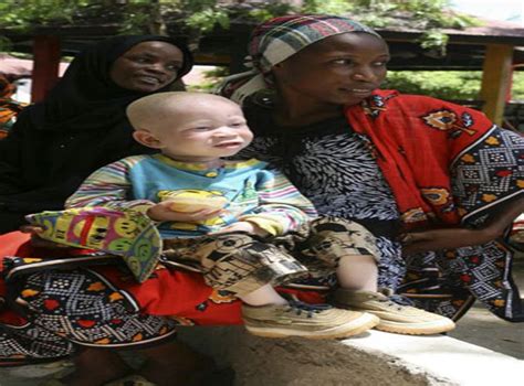 Witch Doctors Arrested After Albino Woman Murdered For Potions In