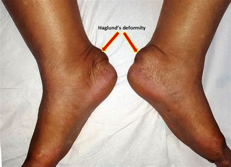 Haglunds Deformity Lower Limb Deformed Physio Syndrome Health