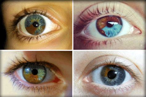 Sectoral Heterochromia Condition Where One Part Of Eye Is Different
