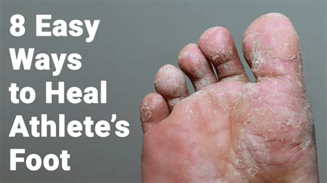 Easy Ways To Heal Athletes Foot