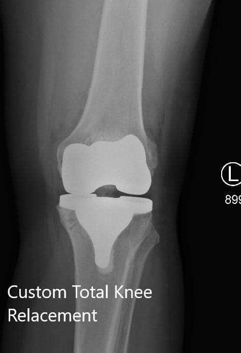 Case Study Custom Left Knee Replacement In 66 Yr Old Female