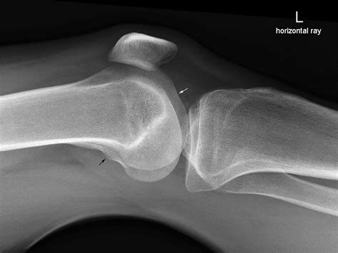 Radiographic Anatomy Knee Horizontal Ray Lateral Medical Images