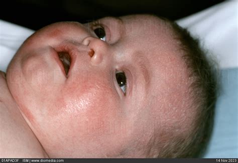 Stock Image An Infant With Leiners Disease Exhibiting Severe