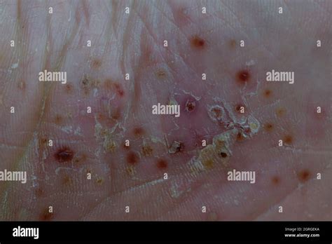 Psoriasis Foot Dermatology Hi Res Stock Photography And Images Alamy
