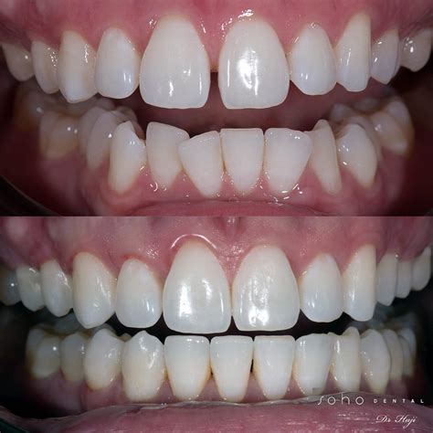 Straightening Your Teeth With Invisalign Soho Dental Toronto Dentist