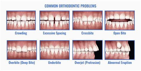 Common Orthodontic Problems Los Angeles And San Diego