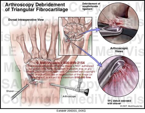 Arthroscopy Debridement Of Triangular Fibrocartilage Medivisuals