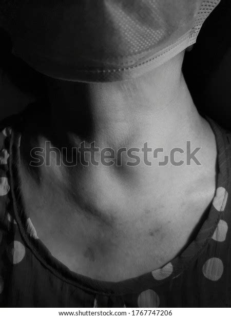 Anterior Neck Swelling Known Medically Goitre Stock Photo 1767747206