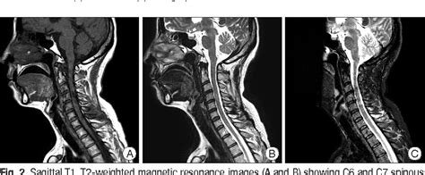Figure 2 From Multiple Cervical Spinous Process Fractures In A Novice