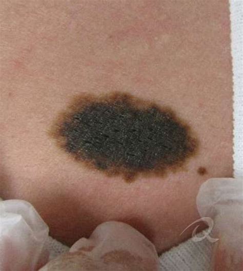 Discover 69 Black Birthmark Tattoo Super Hot Ineteachers