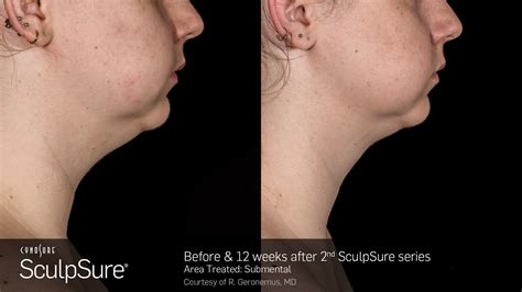 Sculpsure Before And After Gallery De Castro And Basit Mds