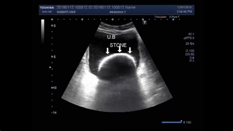 Ultrasound Video Showing A Large Stone In Urinary Bladder With Sludge