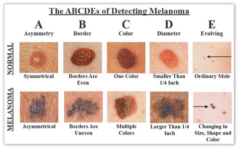 Is It Cancer Know Your Skin Cancer Abcs It Might Save Your Life