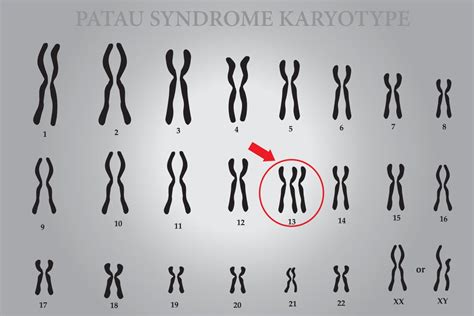 Síndrome de patau trissomia 13 o que é sintomas e cariótipo Dasa