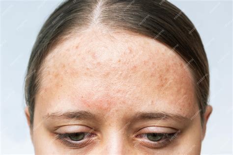 Premium Photo Close Up Of Red Allergic Rash On A Forehead Cropped