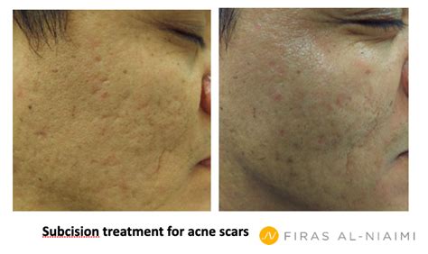 Subcision Treatment For Acne Scars Dr Firas Al Niaimi