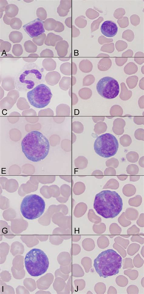 Reactive Lymphocytes In An Older Dog With Atrial Hemangiosarcoma