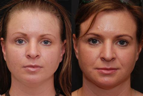 Facial Liposuction Photos Cincinnati Oh Patient 6846
