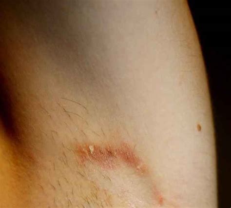 Armpit Rash Fungal Images Galleries With A Bite