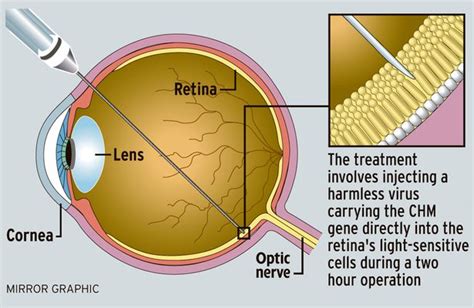 New Viral Gene Therapy Breakthrough Improves Eyesight For The Blind