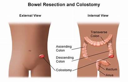 Colostomy Hirschsprung Disease Bowel Colon Resection Intestinal