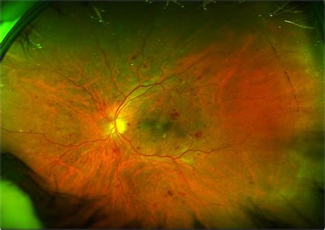 Widefield View Of Fundus Suggestive Of Severe Npdr Note The Ability To